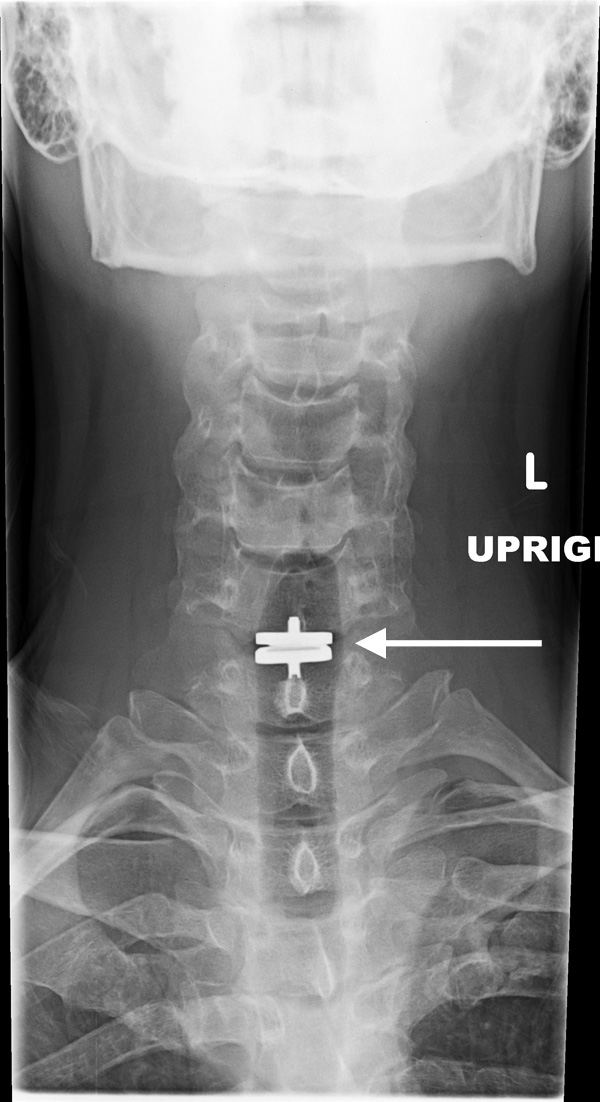 Artificial Disc Replacement Adr Spine Surgeon Vail Aspen Denver Co
