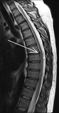 Venlafaxine Effexor Effexor Xr Side Effects Dosages Treatment