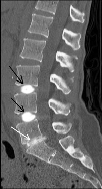 Lumbar Discograms | Lower Back Pain Diagnosis | Colorado