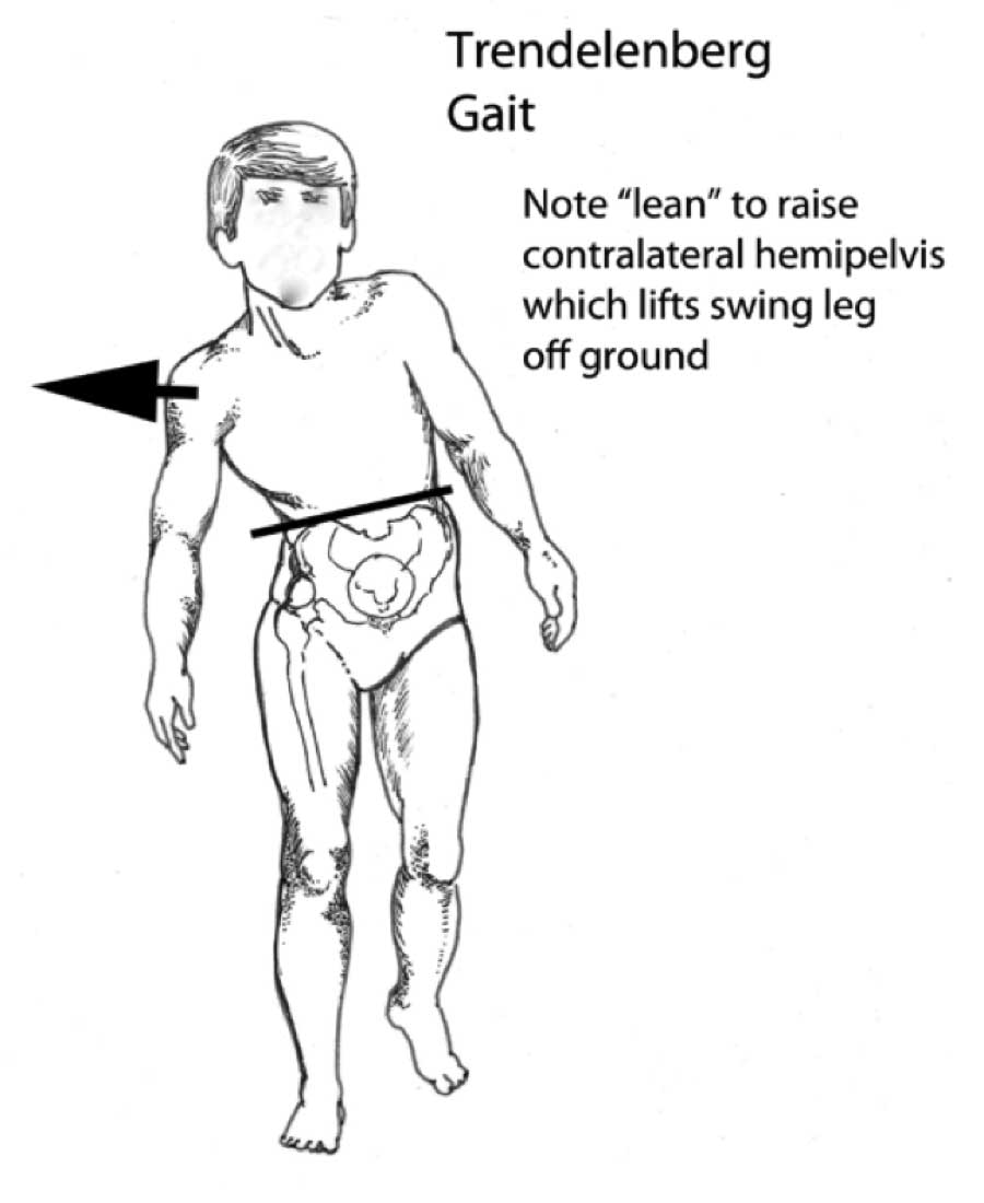 What Does The Word Staggering Gait Mean لم يسبق له مثيل الصور
