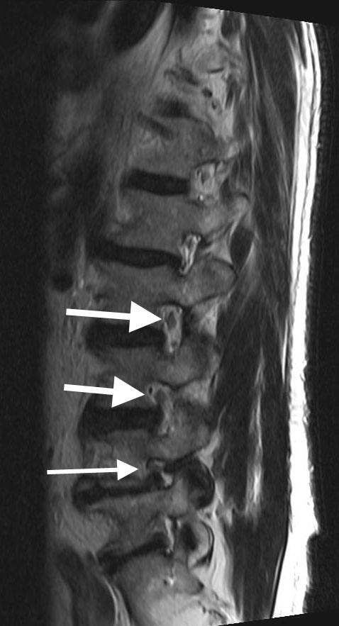 Lumbar Foraminal Stenosis Collapse Of The Lumbar Spine Vail